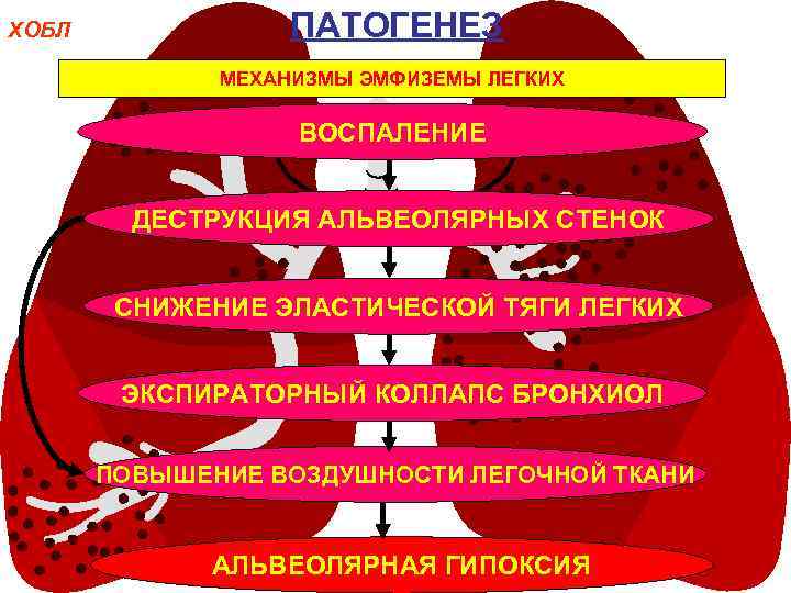 ХОБЛ ПАТОГЕНЕЗ МЕХАНИЗМЫ ЭМФИЗЕМЫ ЛЕГКИХ ВОСПАЛЕНИЕ ДЕСТРУКЦИЯ АЛЬВЕОЛЯРНЫХ СТЕНОК СНИЖЕНИЕ ЭЛАСТИЧЕСКОЙ ТЯГИ ЛЕГКИХ ЭКСПИРАТОРНЫЙ