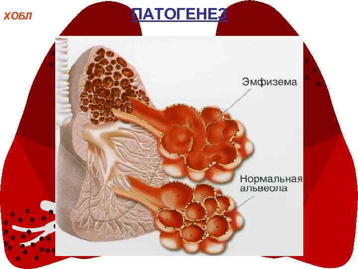 ХОБЛ ПАТОГЕНЕЗ 