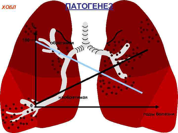 ПАТОГЕНЕЗ ХОБЛ % 100 обратимая необратимая 0 годы болезни 