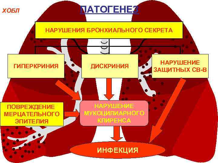 ПАТОГЕНЕЗ ХОБЛ НАРУШЕНИЯ БРОНХИАЛЬНОГО СЕКРЕТА ГИПЕРКРИНИЯ ПОВРЕЖДЕНИЕ МЕРЦАТЕЛЬНОГО ЭПИТЕЛИЯ ДИСКРИНИЯ НАРУШЕНИЕ МУКОЦИЛИАРНОГО КЛИРЕНСА ИНФЕКЦИЯ