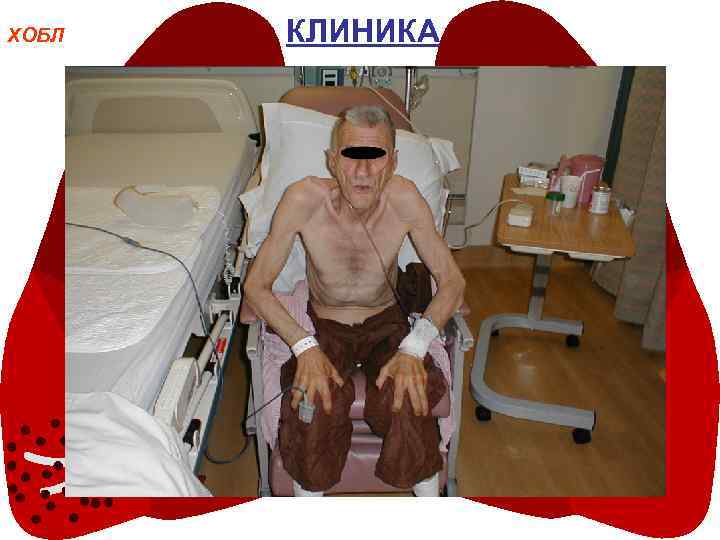 ХОБЛ КЛИНИКА 