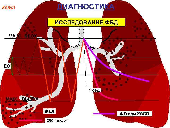 ДИАГНОСТИКА ХОБЛ ИССЛЕДОВАНИЕ ФВД MAКС. ВДОХ ДО 1 сек. МАКС. ВЫДОХ ЖЕЛ ФВ- норма