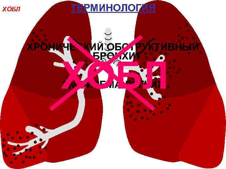 ХОБЛ ТЕРМИНОЛОГИЯ ХРОНИЧЕСКИЙ ОБСТРУКТИВНЫЙ БРОНХИТ ХОБЛ ЭМФИЗЕМА ЛЕГКИХ 