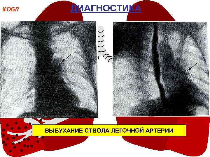 ХОБЛ ДИАГНОСТИКА ВЫБУХАНИЕ СТВОЛА ЛЕГОЧНОЙ АРТЕРИИ 