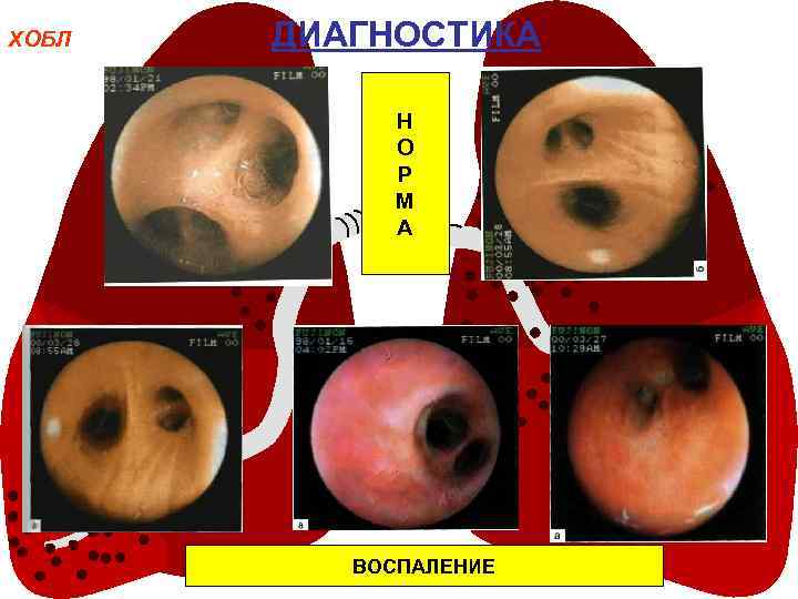 ХОБЛ ДИАГНОСТИКА Н О Р М А ВОСПАЛЕНИЕ 