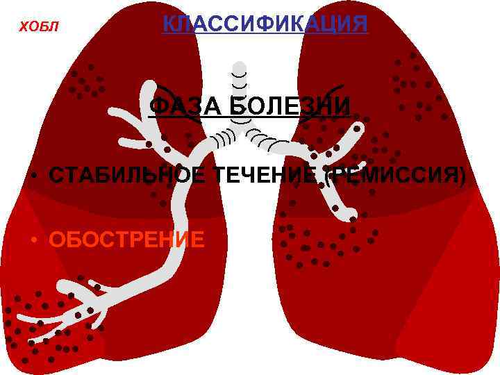 ХОБЛ КЛАССИФИКАЦИЯ ФАЗА БОЛЕЗНИ • СТАБИЛЬНОЕ ТЕЧЕНИЕ (РЕМИССИЯ) • ОБОСТРЕНИЕ 