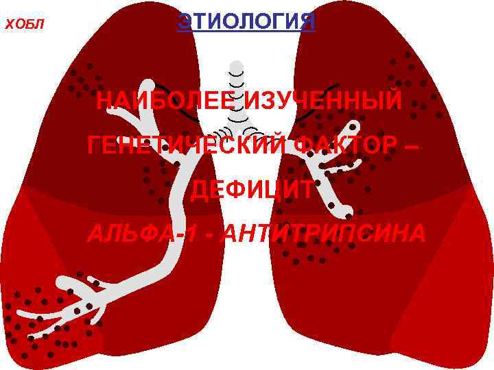 ХОБЛ ЭТИОЛОГИЯ НАИБОЛЕЕ ИЗУЧЕННЫЙ ГЕНЕТИЧЕСКИЙ ФАКТОР – ДЕФИЦИТ АЛЬФА-1 - АНТИТРИПСИНА 