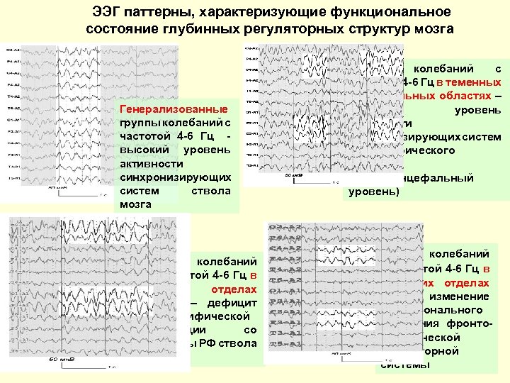 ЭЭГ паттерны, характеризующие функциональное состояние глубинных регуляторных структур мозга Генерализованные группы колебаний с частотой