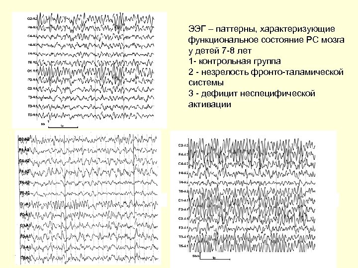 1 2 ЭЭГ – паттерны, характеризующие функциональное состояние РС мозга у детей 7 -8