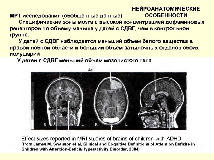 НЕЙРОАНАТОМИЧЕСКИЕ ОСОБЕННОСТИ МРТ исследования (обобщенные данные): Специфические зоны мозга с высокой концентрацией дофаминовых рецепторов