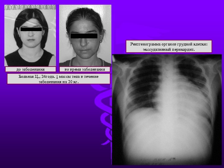 Рентгенограмма органов грудной клетки: экссудативный перикардит. до заболевания во время заболевания Больная Ц. ,