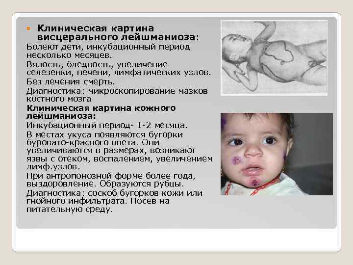  Клиническая картина висцерального лейшманиоза: Болеют дети, инкубационный период несколько месяцев. Вялость, бледность, увеличение