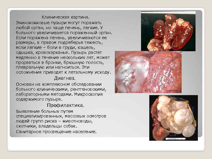 Клиническая картина. Эхинококковые пузыри могут поражать любой орган, но чаще печень, легкие. У больного