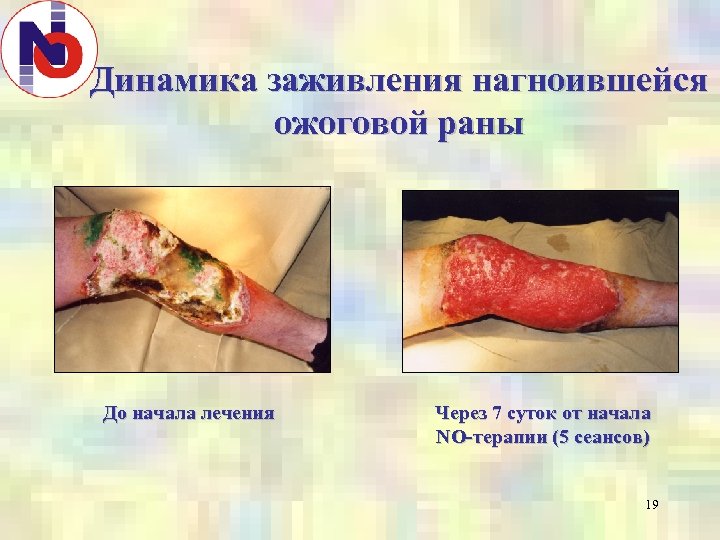 Динамика заживления нагноившейся ожоговой раны До начала лечения Через 7 суток от начала NO-терапии