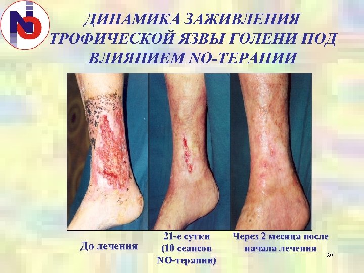 ДИНАМИКА ЗАЖИВЛЕНИЯ ТРОФИЧЕСКОЙ ЯЗВЫ ГОЛЕНИ ПОД ВЛИЯНИЕМ NO-ТЕРАПИИ До лечения 21 -е сутки (10