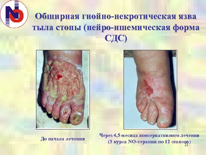 Обширная гнойно-некротическая язва тыла стопы (нейро-ишемическая форма СДС) До начала лечения Через 4, 5