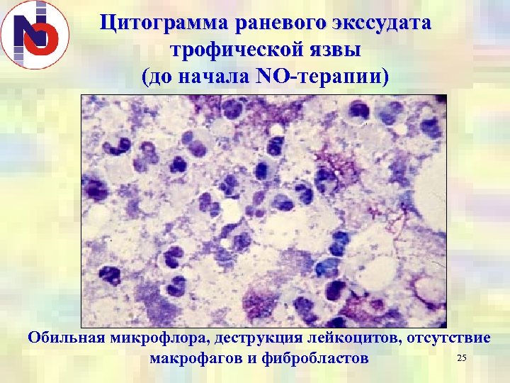 Цитограмма раневого экссудата трофической язвы (до начала NO-терапии) Обильная микрофлора, деструкция лейкоцитов, отсутствие 25