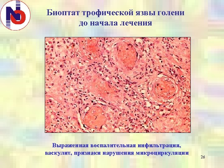 Биоптат трофической язвы голени до начала лечения Выраженная воспалительная инфильтрация, васкулит, признаки нарушения микроциркуляции