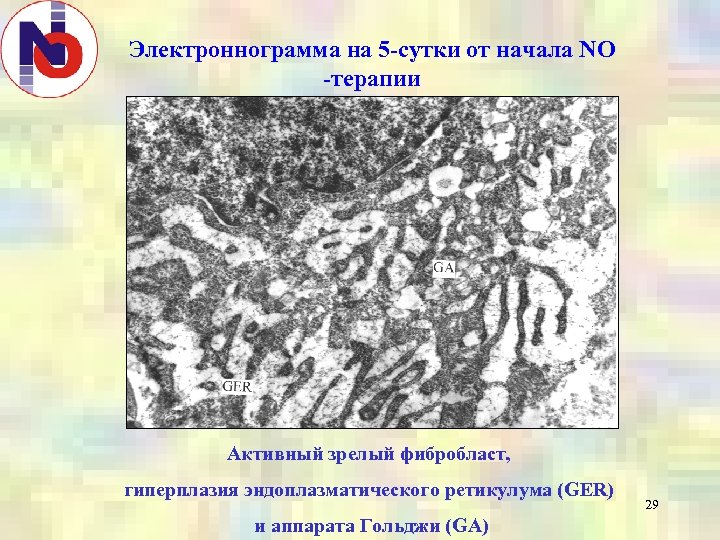 Электроннограмма на 5 -сутки от начала NO -терапии Активный зрелый фибробласт, гиперплазия эндоплазматического ретикулума