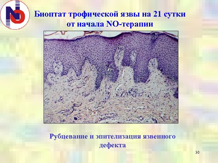 Биоптат трофической язвы на 21 сутки от начала NO-терапии Рубцевание и эпителизация язвенного дефекта