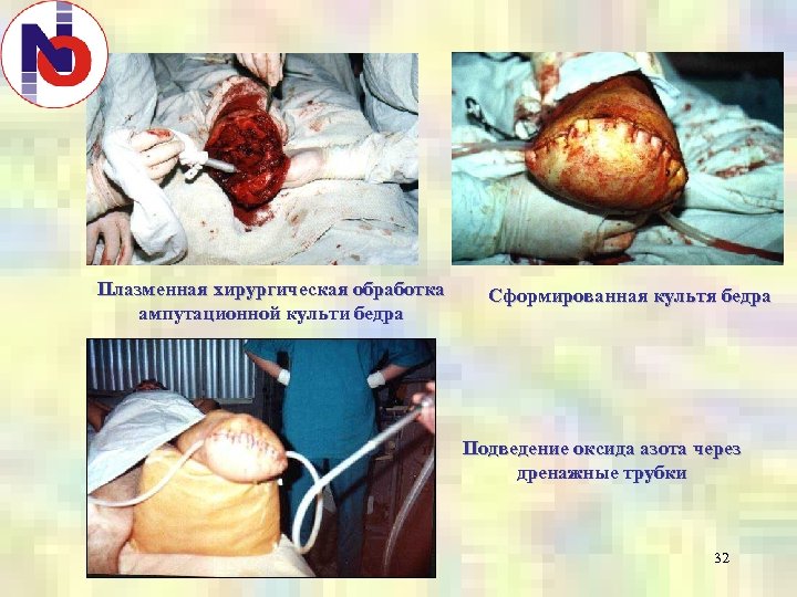 Плазменная хирургическая обработка ампутационной культи бедра Сформированная культя бедра Подведение оксида азота через дренажные