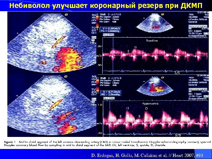 Небиволол улучшает коронарный резерв при ДКМП D. Erdogan, H. Gullu, M. Caliskan et al.