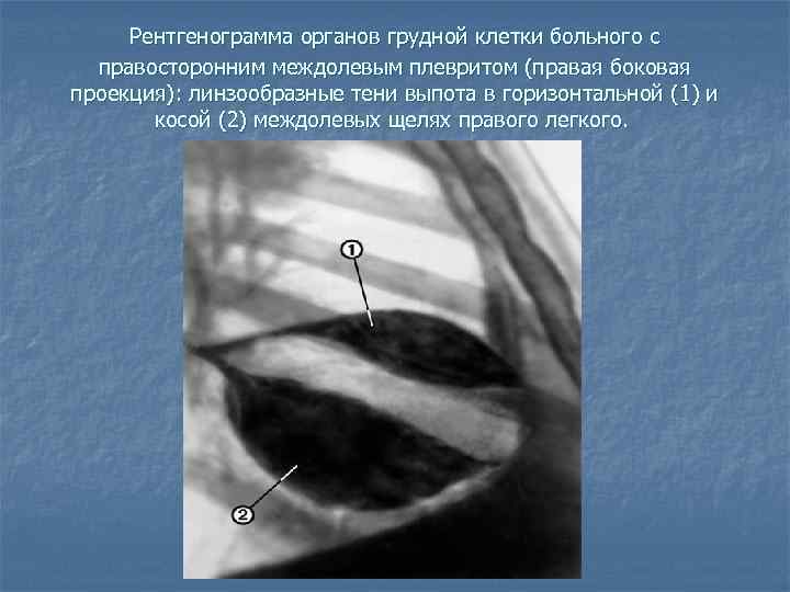  Рентгенограмма органов грудной клетки больного с правосторонним междолевым плевритом (правая боковая проекция): линзообразные