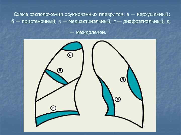 Плеврит карта вызова