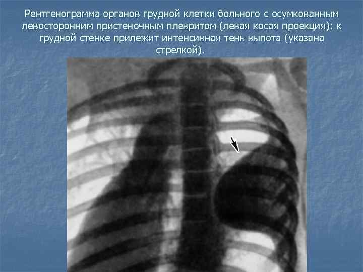 Экссудативный плеврит рентгенологическая картина