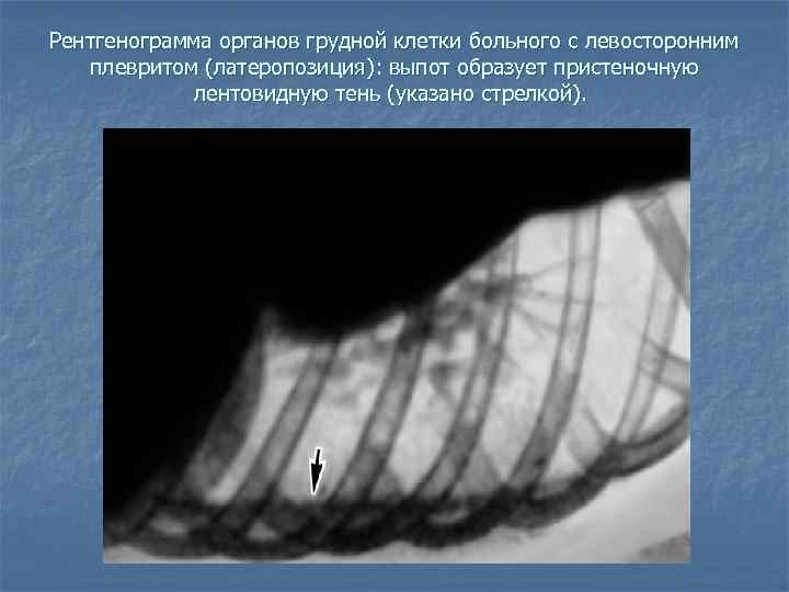 Рентгенограмма органов грудной клетки больного с левосторонним плевритом (латеропозиция): выпот образует пристеночную лентовидную тень