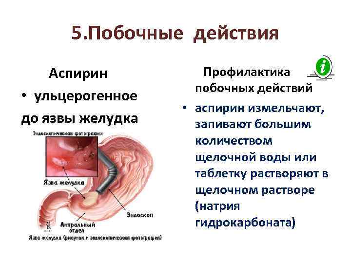 5. Побочные действия Аспирин • ульцерогенное до язвы желудка Профилактика побочных действий • аспирин