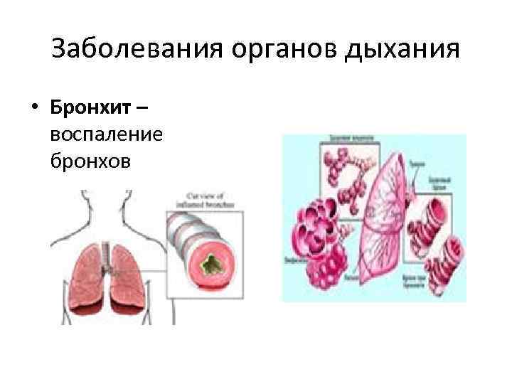 Заболевания органов дыхания • Бронхит – воспаление бронхов 