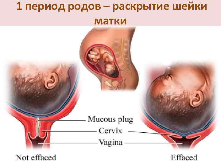 1 период родов – раскрытие шейки матки 