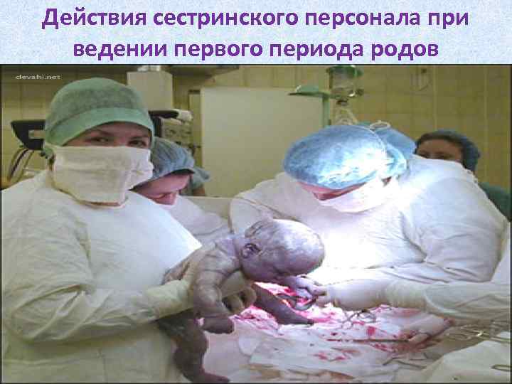 Действия сестринского персонала при ведении первого периода родов 