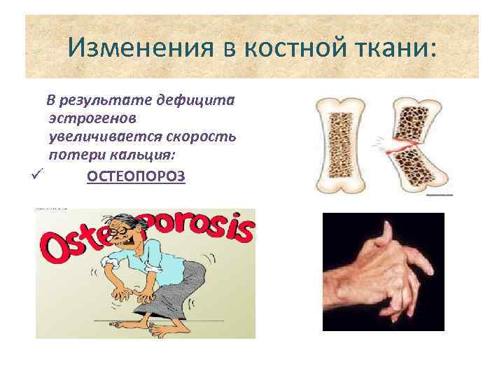 Изменения в костной ткани: В результате дефицита эстрогенов увеличивается скорость потери кальция: ü ОСТЕОПОРОЗ