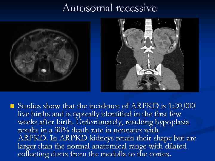 Autosomal recessive n Studies show that the incidence of ARPKD is 1: 20, 000