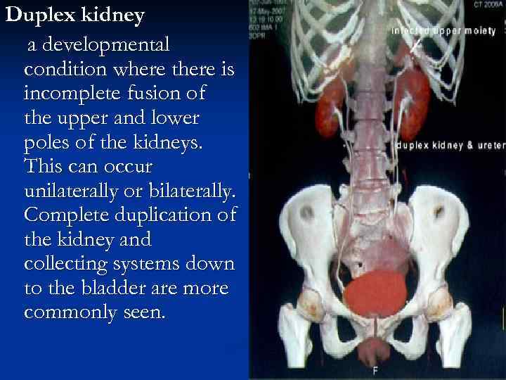 Duplex kidney a developmental condition where there is incomplete fusion of the upper and