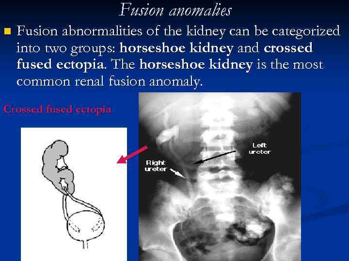 Fusion anomalies n Fusion abnormalities of the kidney can be categorized into two groups: