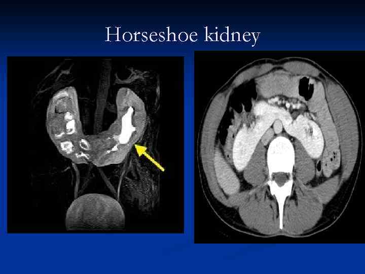 Horseshoe kidney 