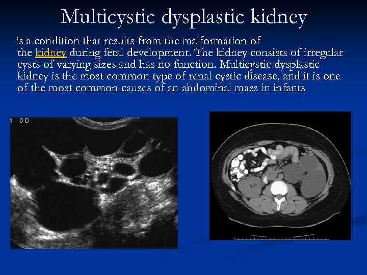 Multicystic dysplastic kidney is a condition that results from the malformation of the kidney