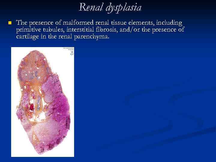 Renal dysplasia n The presence of malformed renal tissue elements, including primitive tubules, interstitial