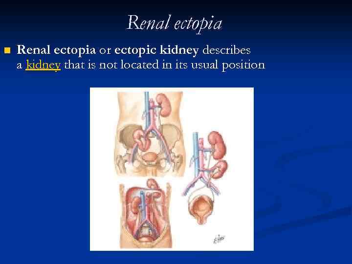 Renal ectopia n Renal ectopia or ectopic kidney describes a kidney that is not