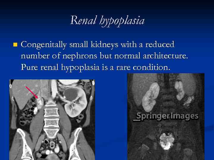 Renal hypoplasia n Congenitally small kidneys with a reduced number of nephrons but normal