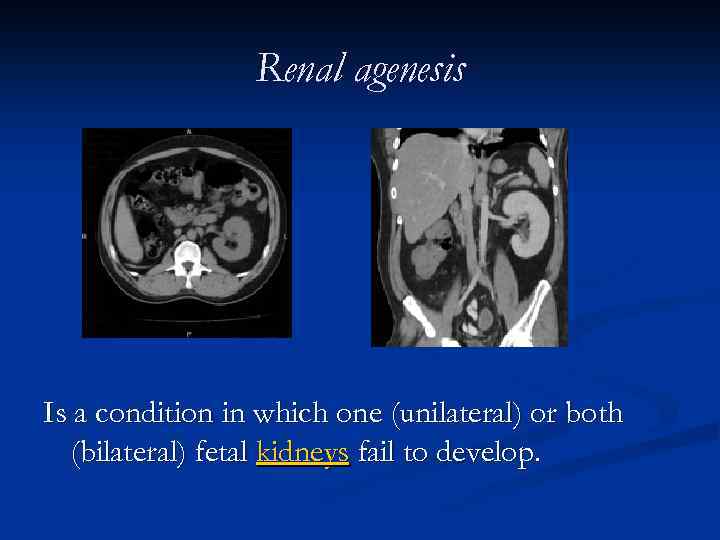 Renal agenesis Is a condition in which one (unilateral) or both (bilateral) fetal kidneys