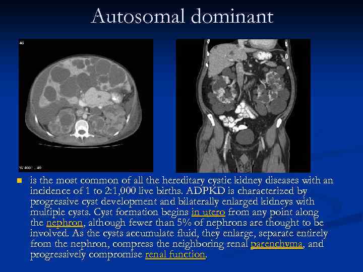 Autosomal dominant n is the most common of all the hereditary cystic kidney diseases