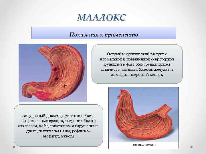 МААЛОКС Показания к применению Острый и хронический гастрит с нормальной и повышенной секреторной функцией