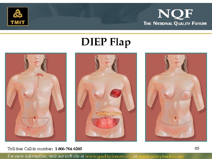 DIEP Flap Toll-free Call-in number: 1 -866 -764 -6260 65 