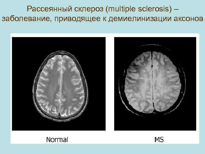 Рассеянный склероз (multiple sclerosis) – заболевание, приводящее к демиелинизации аксонов 