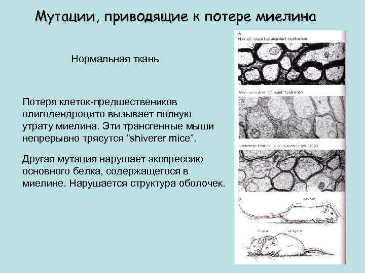 Мутации, приводящие к потере миелина Нормальная ткань Потеря клеток-предшествеников олигодендроцито вызывает полную утрату миелина.