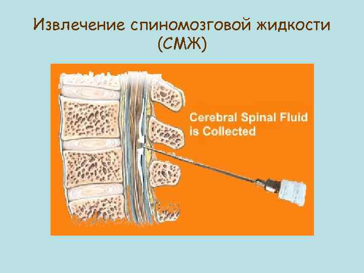 Извлечение спиномозговой жидкости (СМЖ) 